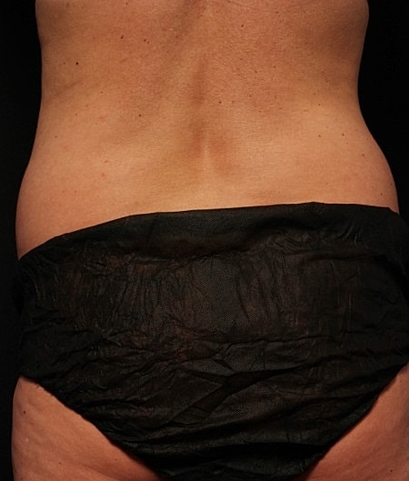 Coolsculpting Before & After