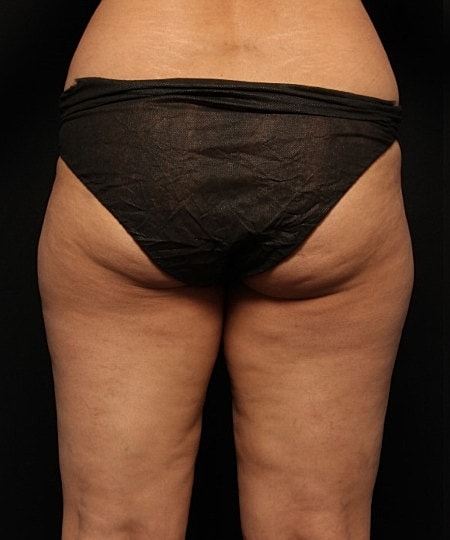 Coolsculpting Before & After