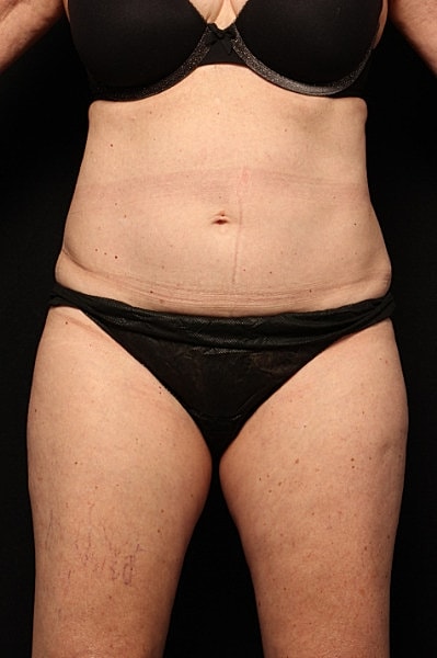 Coolsculpting Before & After