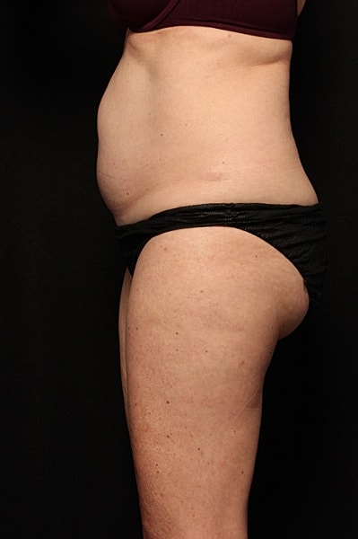 Coolsculpting Before & After