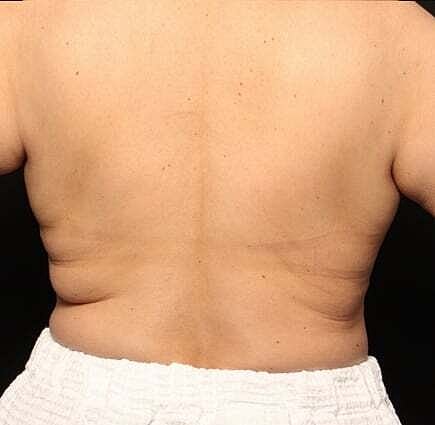 Coolsculpting Before & After