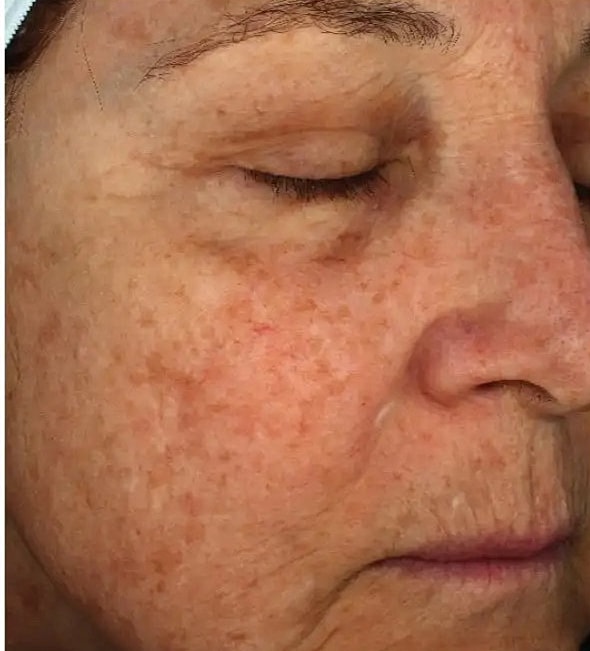 Why choose Halo over other laser procedures