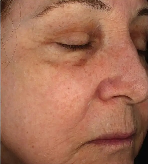 Why choose Halo over other laser procedures