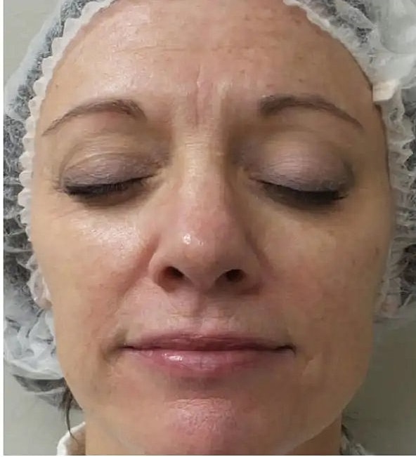 Why choose Halo over other laser procedures