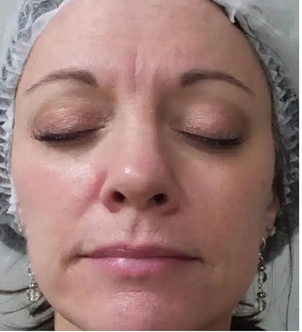 Why choose Halo over other laser procedures