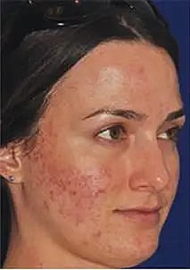 Before and after skinpen treatments