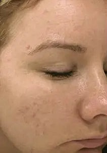 Before and after skinpen treatments