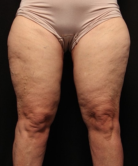Thigh Lift Before & After