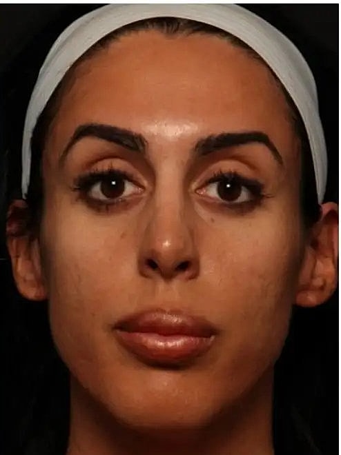 laser resurfacing to renew face skin