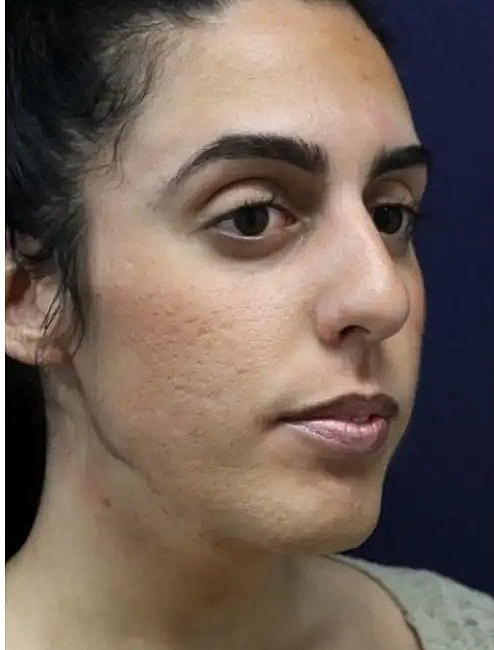 laser resurfacing to renew face skin