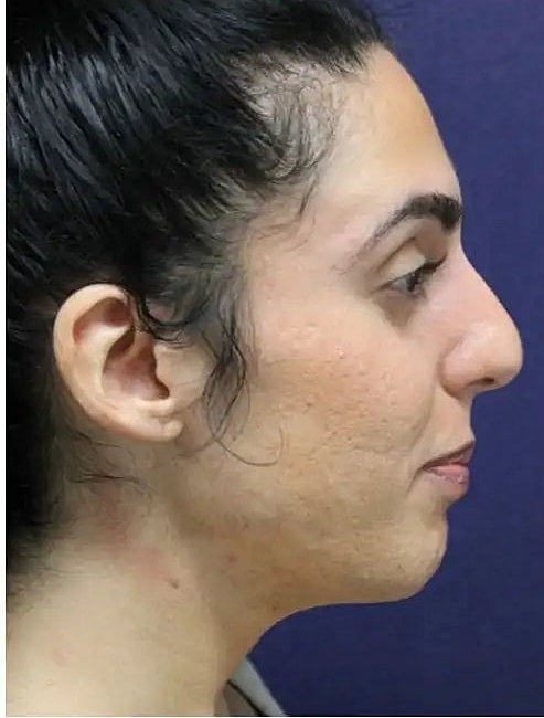 laser resurfacing to renew face skin