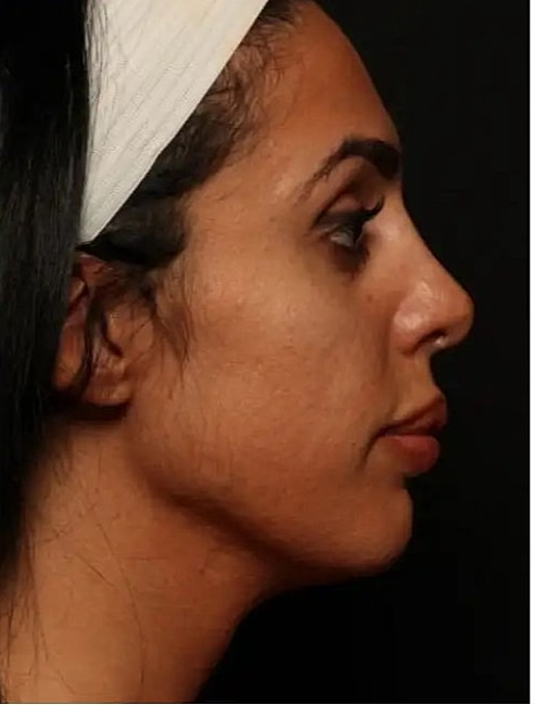 laser resurfacing to renew face skin