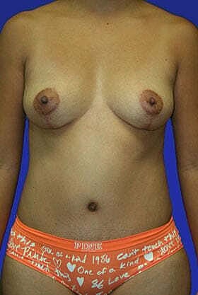 Mommy Makeover Before & After