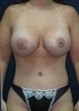 Mommy Makeover Before & After