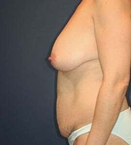 Mommy Makeover Before & After