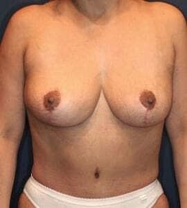 Mommy Makeover Before & After