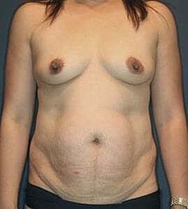 Mommy Makeover Before & After