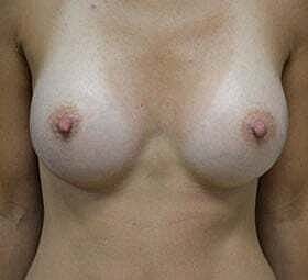 Breast Augmentation Before & After