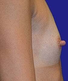 Breast Augmentation Before & After