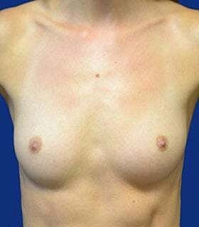 Breast Augmentation Before & After