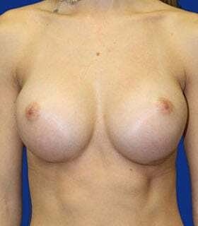 Breast Augmentation Before & After