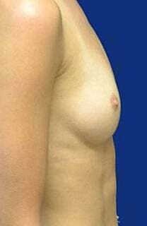 Breast Augmentation Before & After