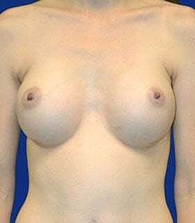 Breast Augmentation Before & After