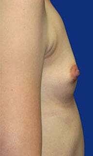 Breast Augmentation Before & After