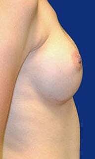 Breast Augmentation Before & After