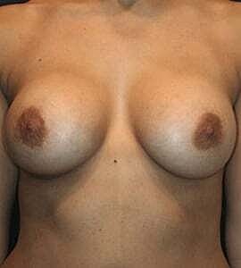 Breast Augmentation Before & After