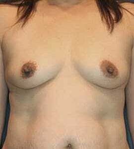 Breast Augmentation Before & After