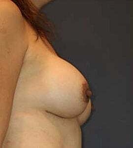 Breast Augmentation Before & After