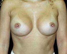 Breast Augmentation Before & After