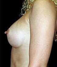 Breast Augmentation Before & After