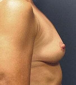 Breast Augmentation Before & After