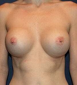 Breast Augmentation Before & After