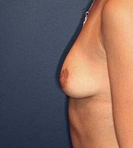 Breast Augmentation Before & After
