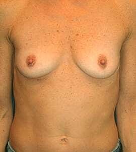 Breast Augmentation Before & After