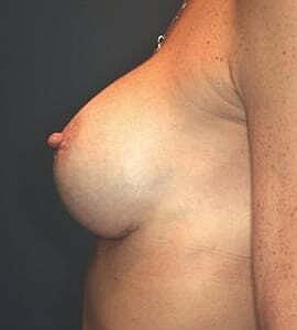 Breast Augmentation Before & After