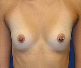 Breast Augmentation Before & After