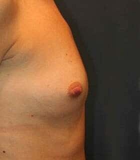 Breast Augmentation Before & After