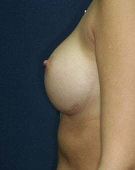 Breast Augmentation Before & After