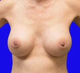 Breast Augmentation Before & After