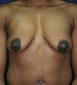 Breast Augmentation Before & After