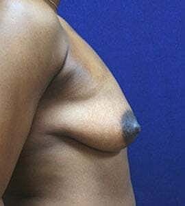 Breast Augmentation Before & After