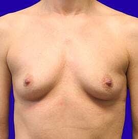Breast Augmentation Before & After
