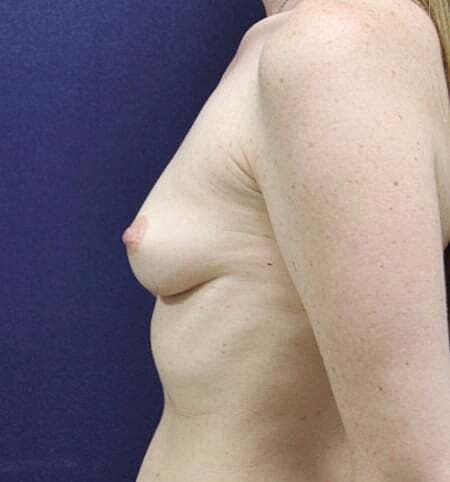 Breast Augmentation Before & After