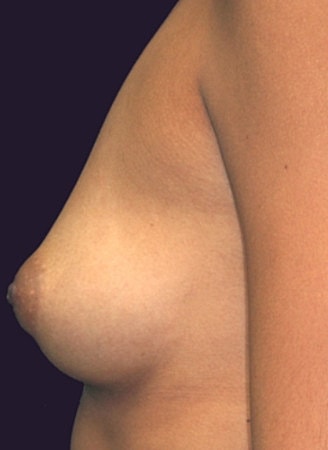 Breast Augmentation Before & After