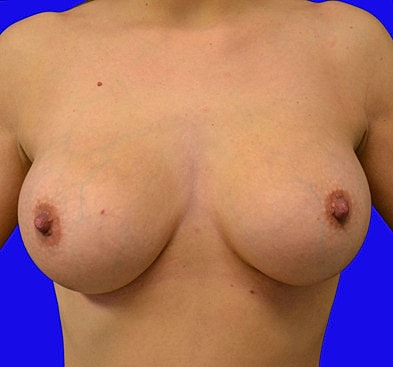 Breast Augmentation Before & After
