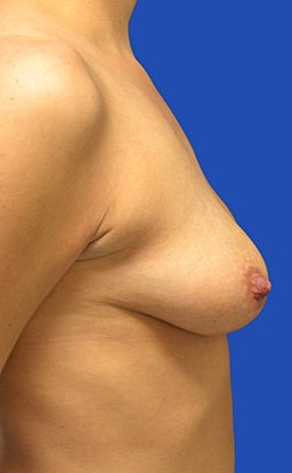Breast Augmentation Before & After